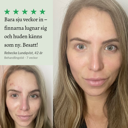 Radiance Ritual | Professionell High Frequency Terapi Hemma